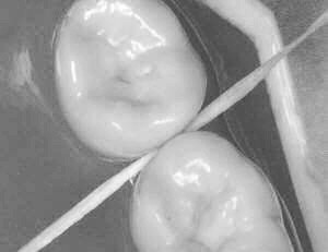 Zahnseide durch Kontakt